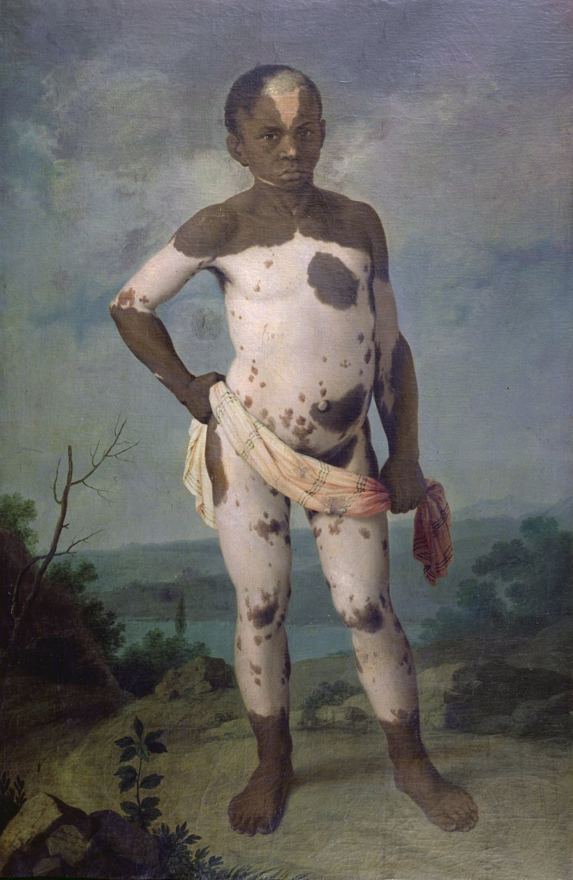 Barn med vitiligo, 1786 af Brazilian School