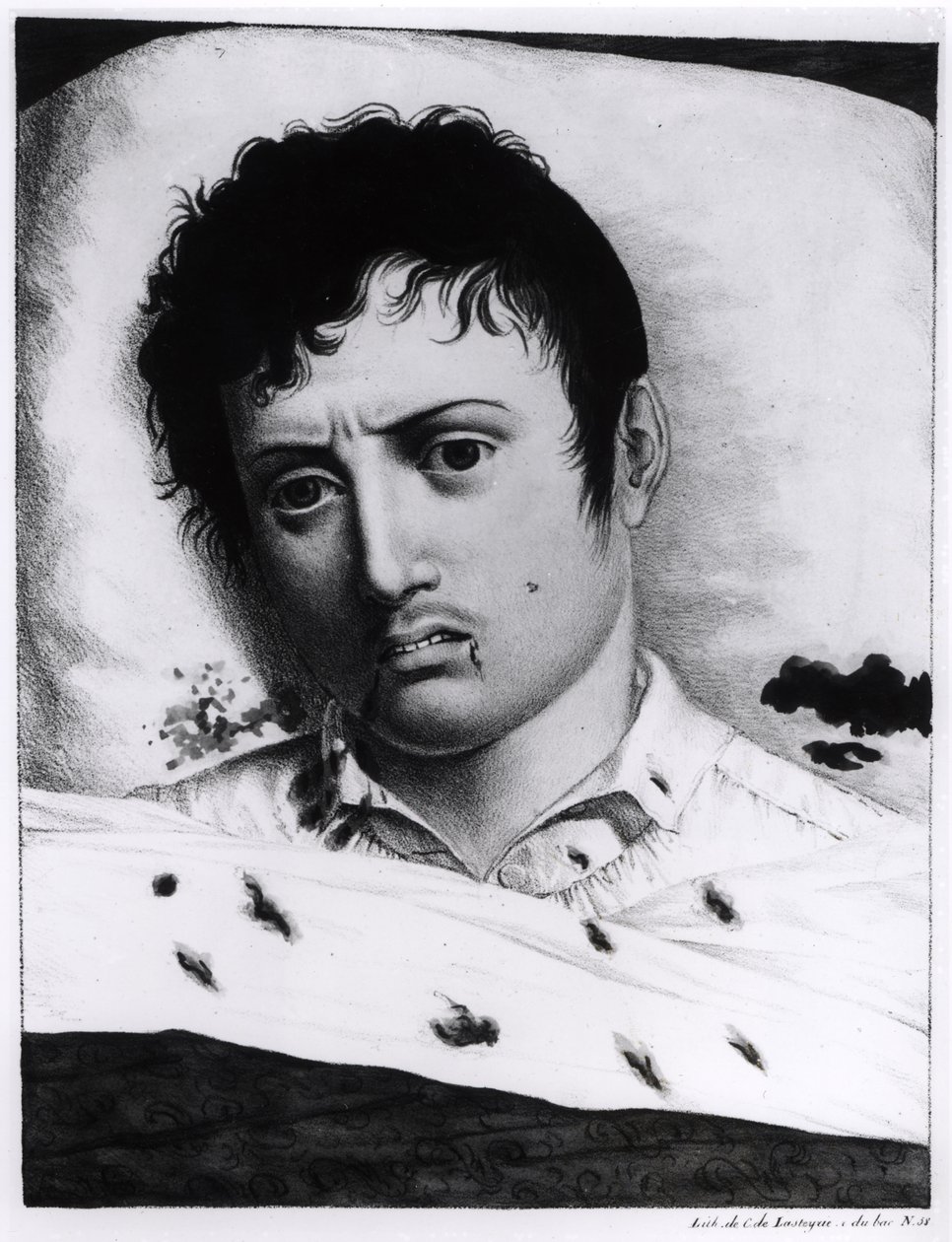 Observation af gul feber, ca. 1819 af Charles Lasteyrie du Saillant