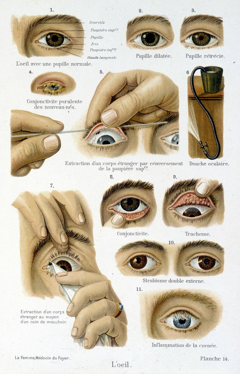 Medicin: øjet. af French School