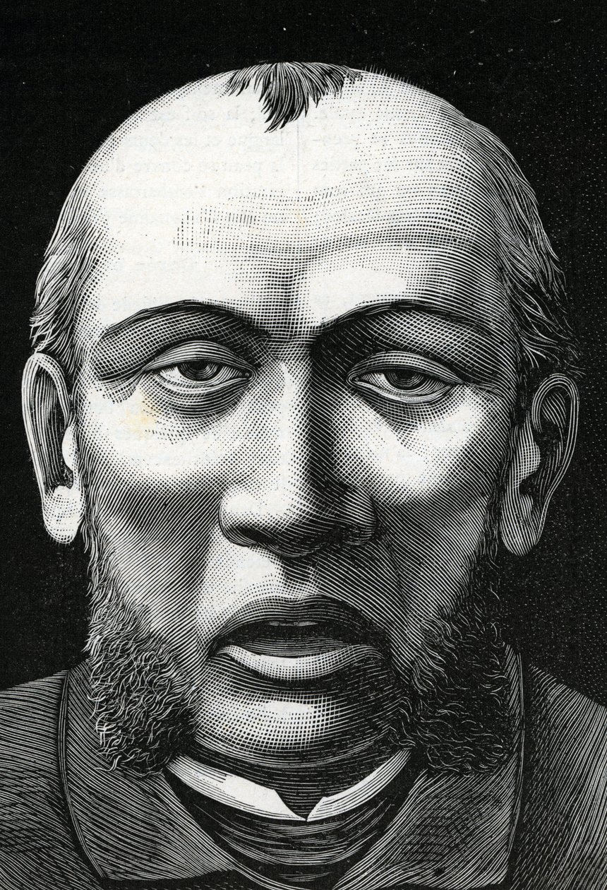 Patient med cerebral blødgøring (gravering) 1888 af French School