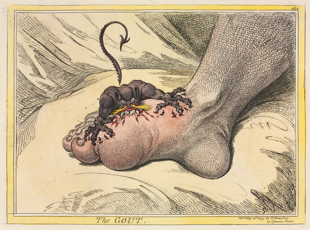 Gigten af James Gillray