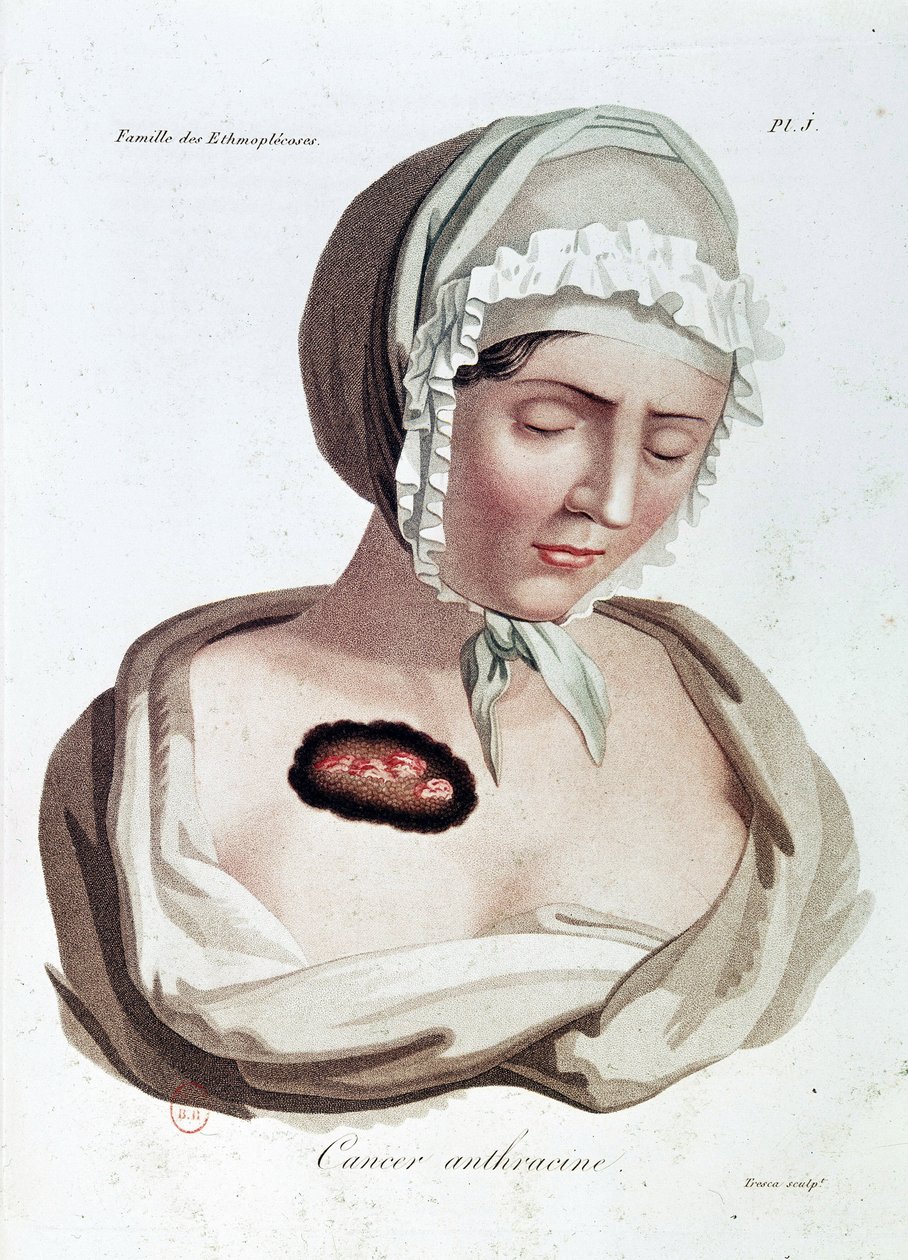 Antracin kræft - Alibert, B.N. af Jean Louis Alibert