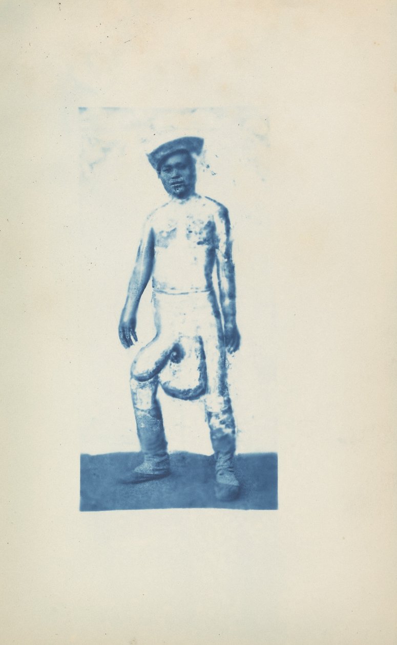 Elefantiasis, ca. 1870
