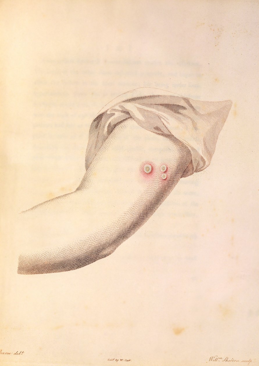 Arm of William Pead brugt til koppevaccine, fra 
