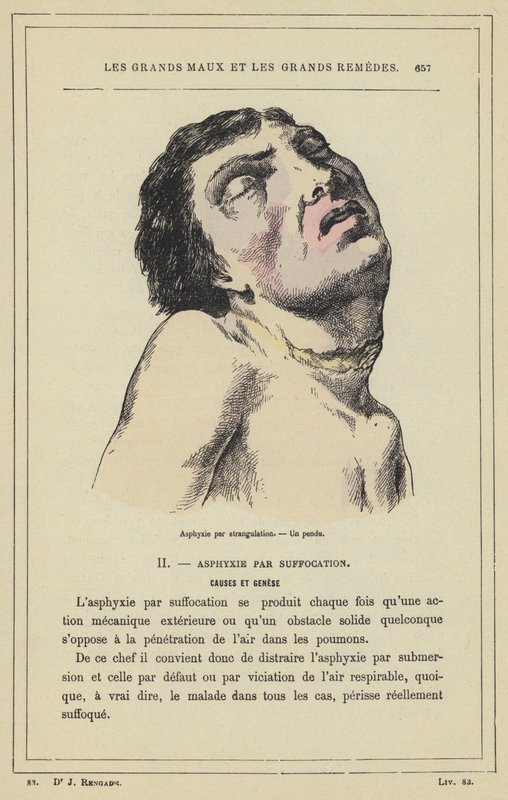 Kvælning ved kvælning, En hængt mand (farve litho) af French School