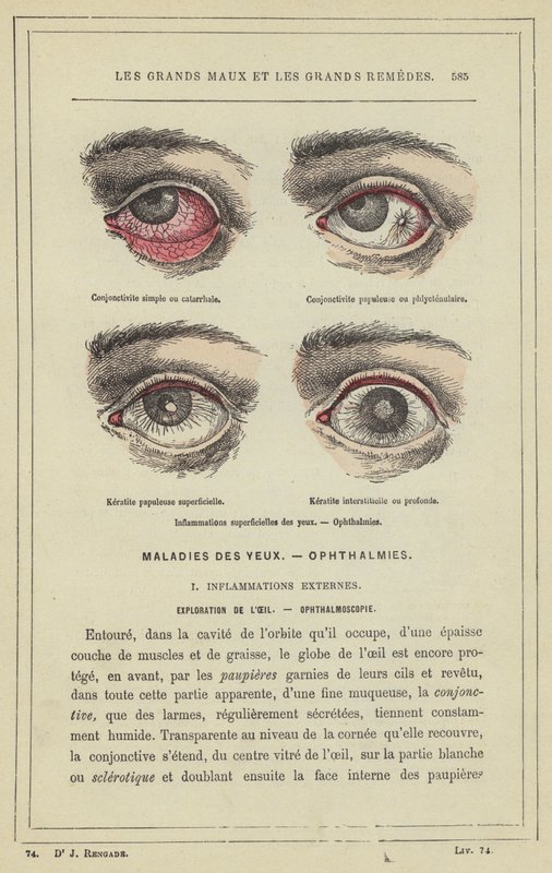Overfladiske øjenbetændelser, oftalmi (farve litho) af French School