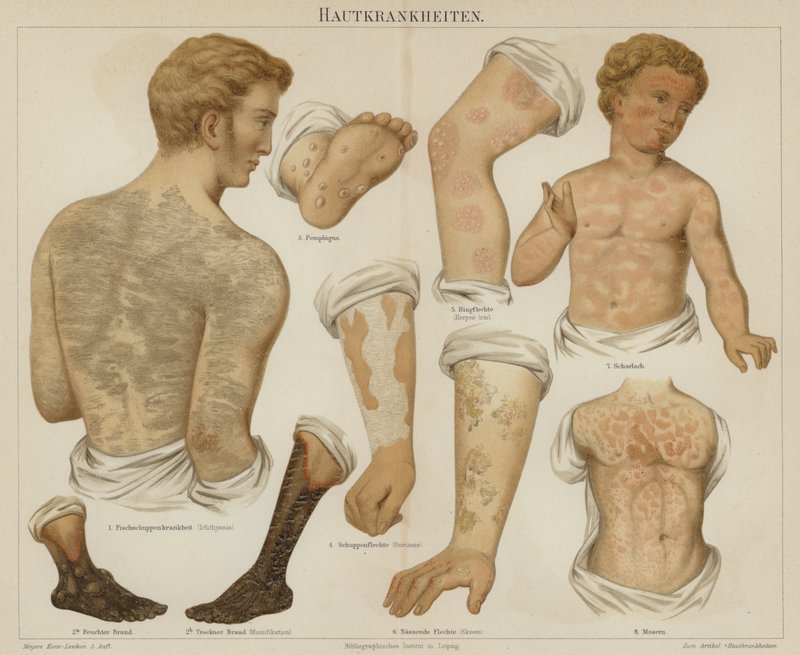 Hudlidelser (farve litho) af German School